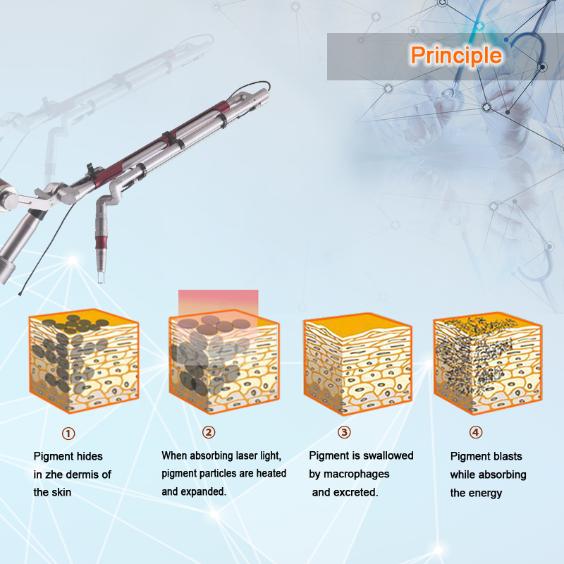 laser tattoo removal equipment attrezzatura per la rimozione dei tatuaggi laser