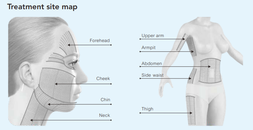 HIFu treatment Trattamento HIFu