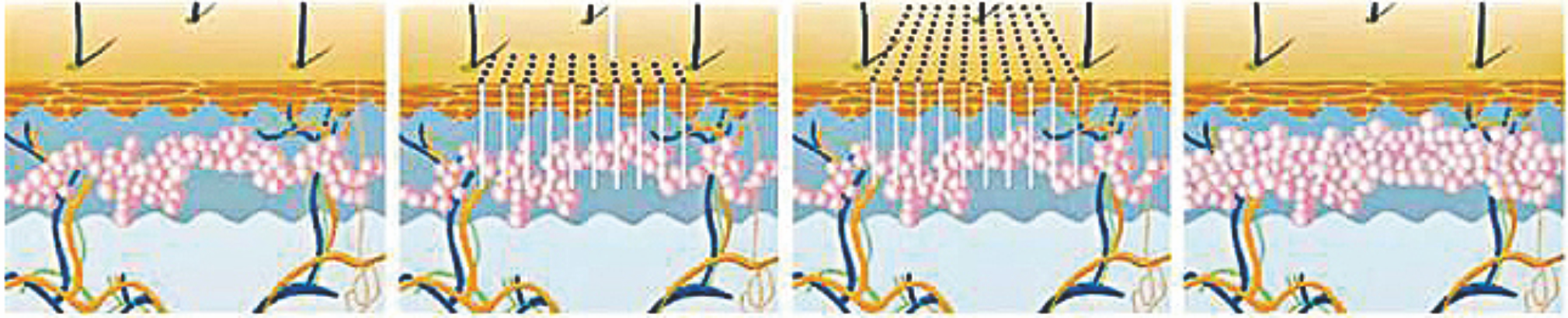 1550nm Erbium Fiber Laser----Deep remodeling Laser in fibra di Erbio da 1550 nm ---- Rimodellamento profondo