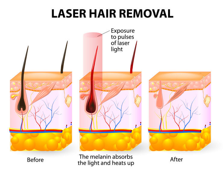 triple diode laser principle principio del laser a triplo diodo