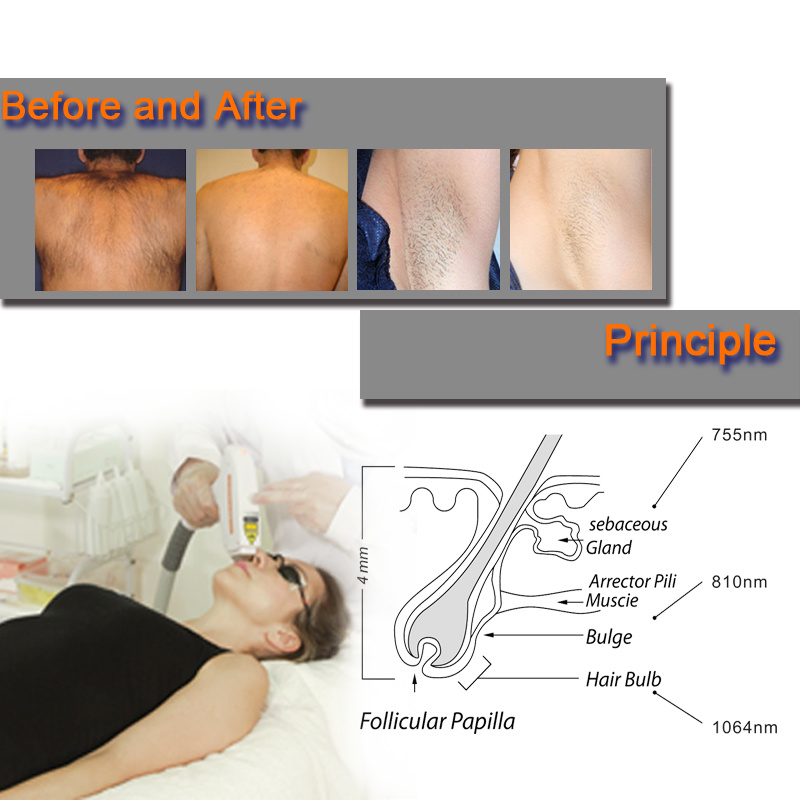 Macchina laser a diodi 8101