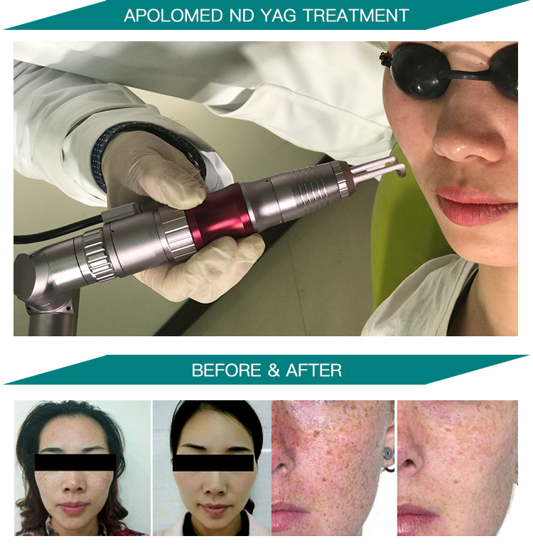 HS-298 foto prima e dopo