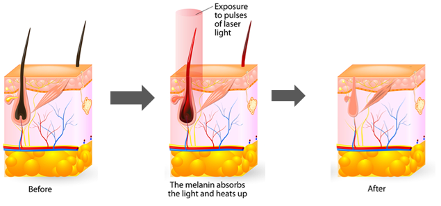 A cosa serve il laser a diodi 810 nm?