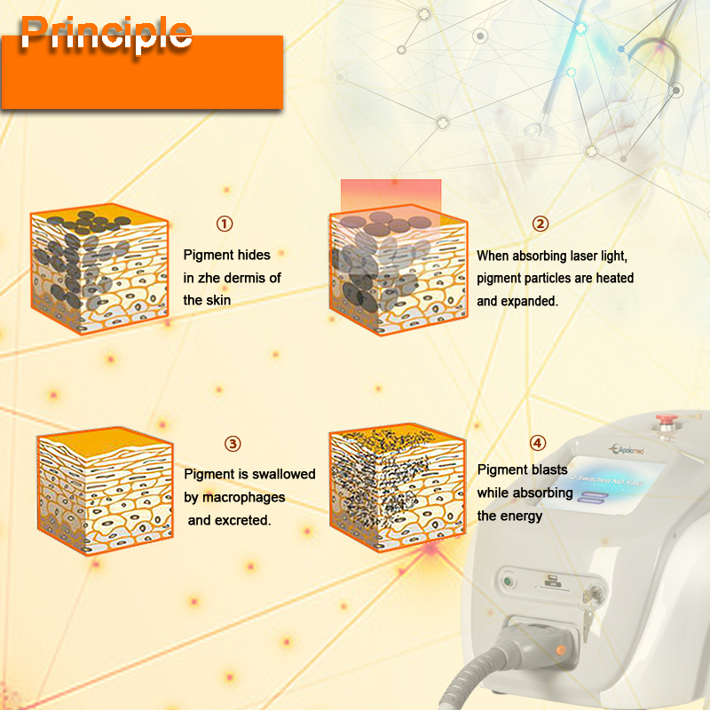 q cambiare la rimozione del tatuaggio 