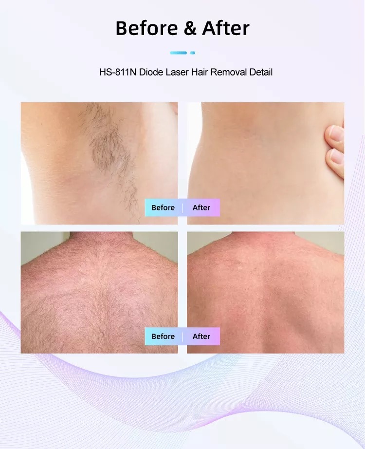 Fabbrica di macchine per la depilazione laser a diodi HS-811