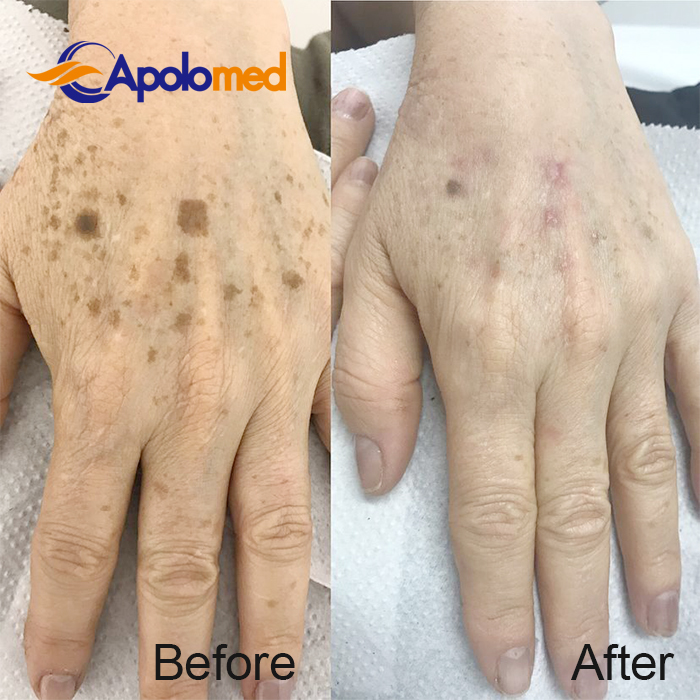 Macchina laser Nd YAG Q-Swithced prima dopo