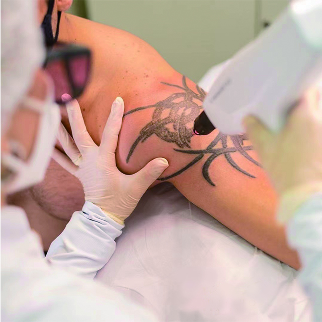 Perché la rimozione laser per tatuaggi è così costosa?